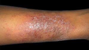 Image result for skin rash similar to scabies