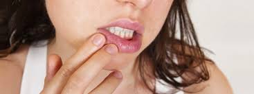 Maries munsår var egentligen bältros. Https Xn Bltros Bua Nu Maries Munsar Var Egentligen Baltros