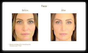 Check spelling or type a new query. Aqua Gold Microneedling Mecca Spa Nj