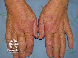 Image result for Photodermatitis