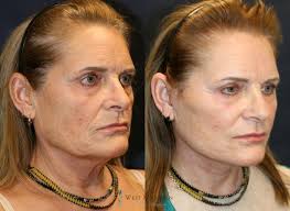 Facelift Before and After Pictures Case 9324