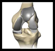 Learn how artificial knee joints work, who are the knee replacement can help relieve pain from joint trauma or degenerative disease like osteoarthritis. What Happens During Partial Knee Replacement Stryker