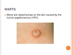 It can also be &quot;malignant&quot; Skin Cancer And Warts