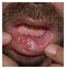 It usually presents as a hard lump with a scaly top but can also form an ulcer. A Frontal View Of Patient With Lower Lip Squamous Cell Carcinoma B Download Scientific Diagram
