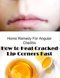 12 Remedies To Heal And Caring Cracked Lip Corners Fast Cracked Lips Chapped Lips Remedy Healing Dry Skin