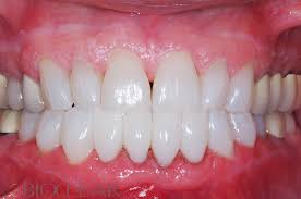 Image result for dental Triangles