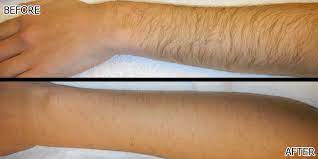 Reputed clinics in india would charge around rs.10,000 to 20,000 per session for full body hair removal. Laser Hair Removal Price Discount Faq Richmond Hill