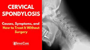 Cervical Spondylosis Causes, Symptoms And Treatment (No Surgery) - Youtube