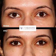 A Canthoplasty Is A Type Of Eye Lift To Create The Coveted Cat Eye Shape It Alters The Corner Where The Eyelid Eye Lift Surgery Eye Lift Rhinoplasty Nose Jobs