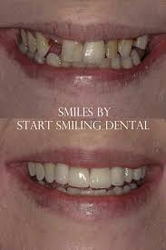 Dental Implants Smile Makeover In Atlanta Ga This Patient Had Been Unhappy With The Uneven Shape Of Her Te Smile Dental Dental Implants Cost Dental Makeover