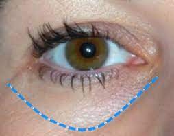 goz alti isik dolgusu nedir goz altindaki cokuk ve mor gorunumun cilt altina verilen bir dolgu maddesi ile tedavisine goz alti isik mor dusuk gozler gozler