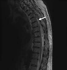 Image result for Spinal Epidural Abscess
