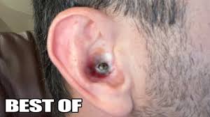 The following are common reasons: Top 10 Ear Pops Ear Blackheads Pimples Zits And Acne Popping Popaholics Youtube