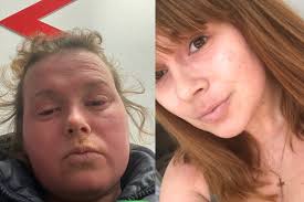 Fundraiser by Chloe Chapman : Chloe's Skin Healing Journey