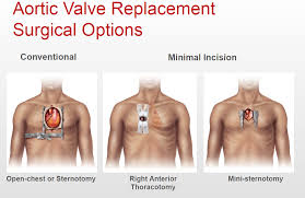 Aortic Valve Replacement Avr Surgical Options Aortic Valve Replacement Bicuspid Aortic Valve Surgery
