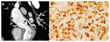 Image result for Cardiovascular Syphilis