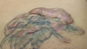 Information and advice about laser tattoo removal, removal cream, tattoo removal cost and more. Tattoo Removal Laser Skin Care