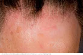 Zinc supplements may help with hair regrowth. Hair Loss Symptoms And Causes Mayo Clinic