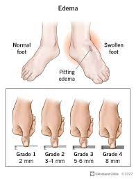 Edema: Causes, Symptoms & Treatment