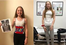 الحزام بعد عملية تصحيح اعوجاج العمود الفقري