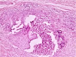 Pathology Outlines Behcet Disease
