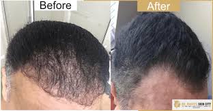 What is laser hair therapy for hair loss? Dr Rachi S Skin City Cold Laser Therapy Treatment Laser Therapy In Vadodara Cold Therapy Services In Vadodara Alkapuri Low Level Laser Therapy Lllt In Vadodara