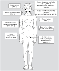 It spreads easily among household members or through kissing. Optimal Management Of Genital Herpes Current Perspectives Idr
