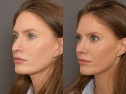 Stephanie's Nose Job Journey with Rhinoplasty London