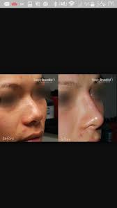 Your face regains its fluid lines. Nose Contour Using Fillers Nose Contouring Skin Medical Skin