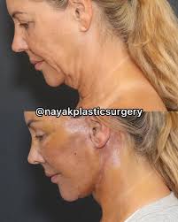 Nicci, 56. 9 days after deep plane facelift, brow lift, lower eyelid  surgery, lip lift, earlobe reductions, a tiny bit of fat transfer, and  lower eyelid laser resurfacing. Video coming soon!