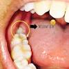 Kemunculan gigi bongsu adalah satu pencapaian pergigian yang umum, namun mereka boleh hadir dengan kesakitan gigi, memicit ke dalam gusi anda dan banyak lagi. 1