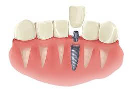 4.3 how much does a full set of teeth implants cost in the uk? Dental Implant Cost How Much Are Dental Implants Single Tooth Without Insurance 2021 Costa Mesa Ca Dentistry At Its Finest