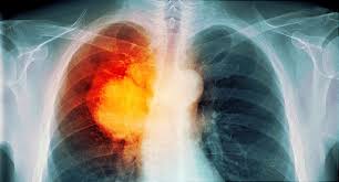 The prognosis is generally one year of life expectancy and depends on the extent to which the liver has been affected by the malignancy. Lung Cancer Pictures X Rays Of Tumors Screening Symptoms And More