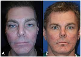 Peri-orbital Aesthetic Rejuvenation Surgical Protocol and Clinical Outcomes 
