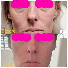 Hollowed under eyes? I deposited bolus of dermal filler in the apex of the  cheeks to soften the hollowness. 😍🤩🤌🏼, @galderma @restylaneusa ,  #cheekfillers💉💉