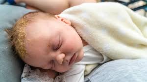 Image result for yellow scabs on the face in children