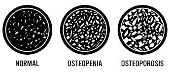 Osteoporosis 3 0 What Your T Score Means For Your Bone