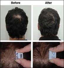 Here are some signs of thinning hair men of all ages should be on the lookout for: Pin On Current Projects