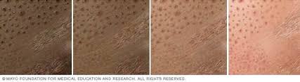 Image result for dermatitis contacta toxica