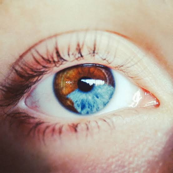 Mga resulta ng larawan para sa sectoral heterochromia. The subject has a blue iris with a brown section."