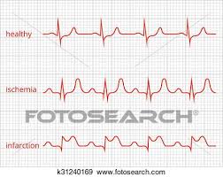 Heart Cardiogram Vector Charts Set Healthy Heart Rhythm