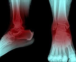 5 Things That Could Be Causing Your Heel Pain