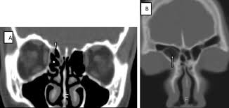 Computed Tomography Anatomy Of The Paranasal Sinuses And Anatomical Variants Of Clinical Relevants In Nigerian Adults Sciencedirect
