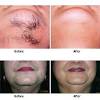 Chin Wax Area