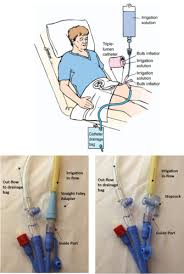 Bladder Irrigation 2 Questions Flashcards Quizlet