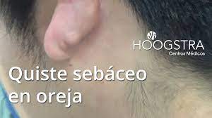 Quiste Sebaceo En Oreja 15147 Youtube