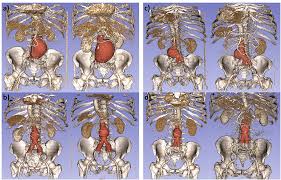 More and more patients are undergoing mri for spinal trauma in the emergency settings, thus necessitating the. Frontiers Image Based 3d Characterization Of Abdominal Aortic Aneurysm Deformation After Endovascular Aneurysm Repair Bioengineering And Biotechnology