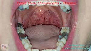 What foods cause tonsil stones? Tonsil Stone Definition Symptoms And Treatment