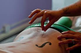 Image result for Acupuncture