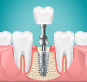 The Advantages and Disadvantages of Zirconia Dental Implants